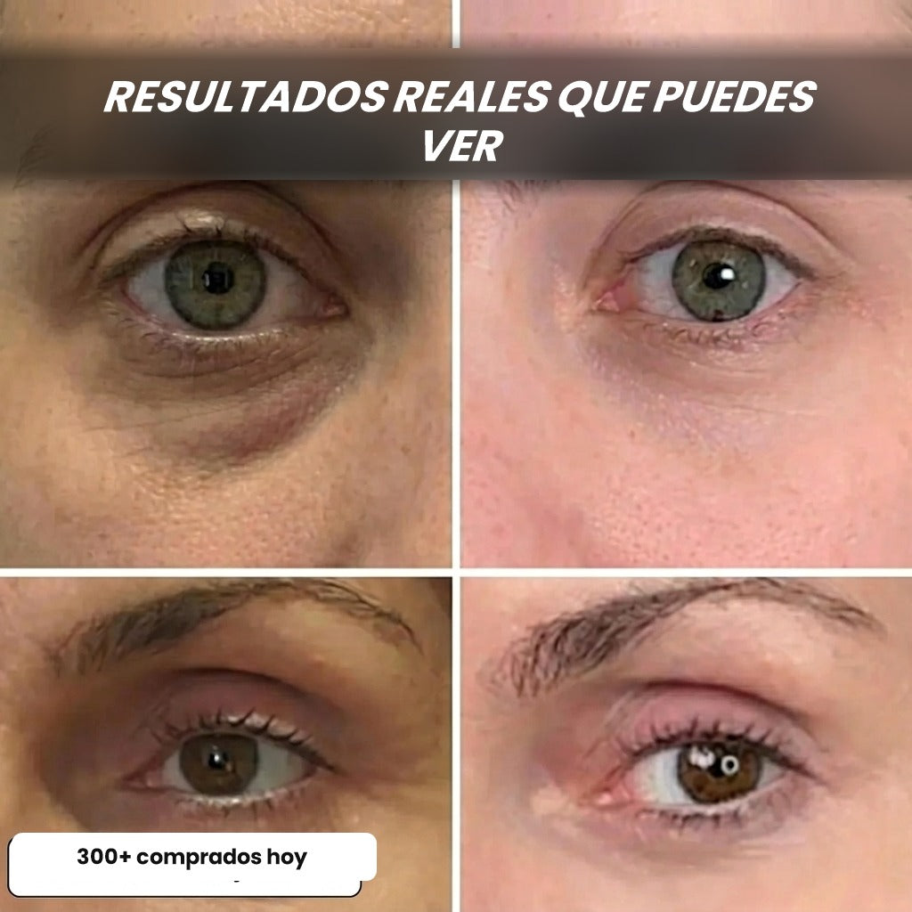 Antes y después en el contorno de ojos y las ojeras