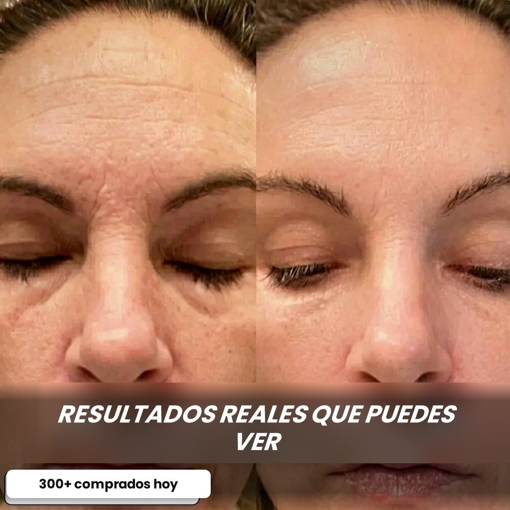 Antes y después en las arrugas de la frente y el entrecejo